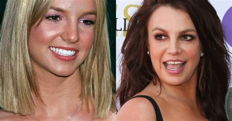 britney spears teeth|Britney Spears Smile: Veneers or All